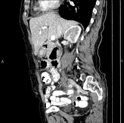 File:Aortic aneurysm and Lemmel syndrome (Radiopaedia 86499-102554 D 34).jpg