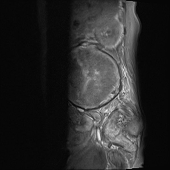 File:Aortic aneurysm with spinal destruction (Radiopaedia 42301-45409 Sagittal T1 fat sat 15).jpg