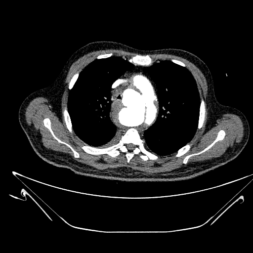 Aortic arch aneurysm (Radiopaedia 84109-99365 B 210).jpg