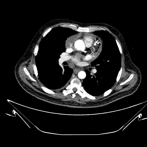 Aortic arch aneurysm (Radiopaedia 84109-99365 B 321).jpg