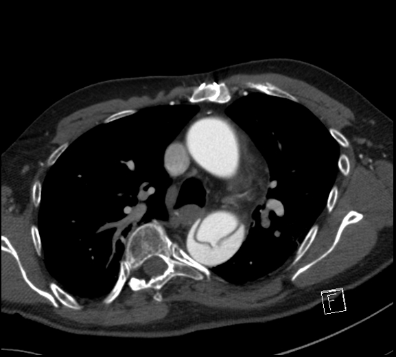 File:Aortic dissection (CTPA) (Radiopaedia 75506-86750 A 35).jpg