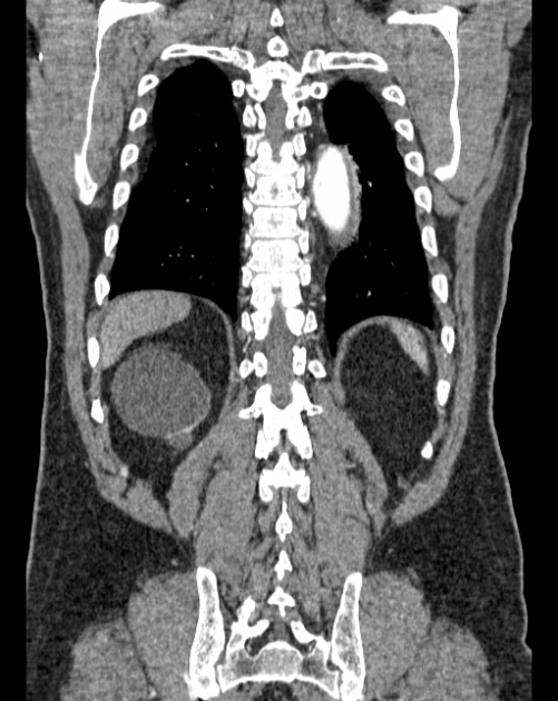 Aortic dissection (Radiopaedia 44411-48061 A 57).jpg