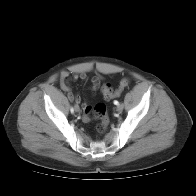 Aortic dissection (Radiopaedia 44411-48061 C 51).jpg