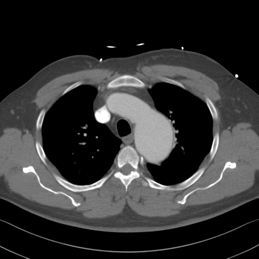 Aortic dissection (Radiopaedia 50763-56234 A 13).png