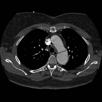 Aortic dissection (Radiopaedia 57969-64959 A 108).jpg