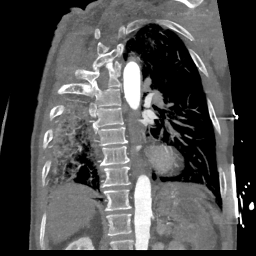 File:Aortic dissection - DeBakey type II (Radiopaedia 64302-73082 D 22).png
