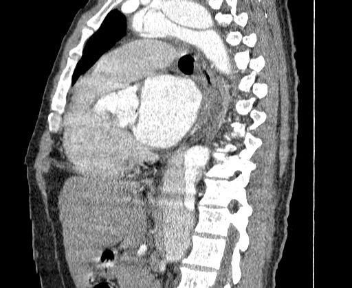 File:Aortic dissection - Stanford A -DeBakey I (Radiopaedia 28339-28587 C 37).jpg