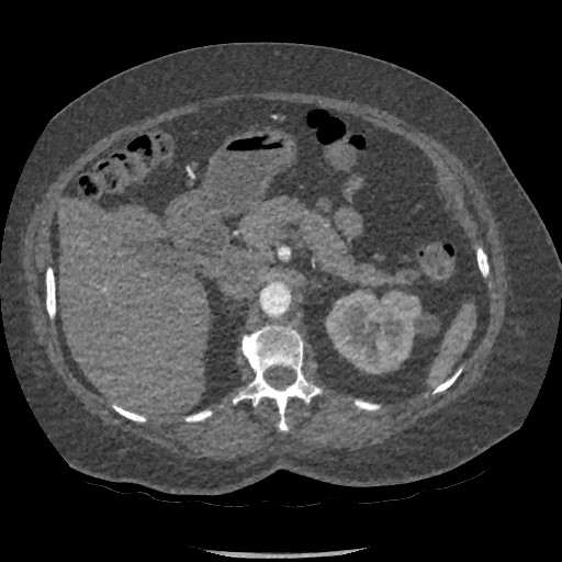 Aortic dissection - Stanford type B (Radiopaedia 88281-104910 A 110).jpg