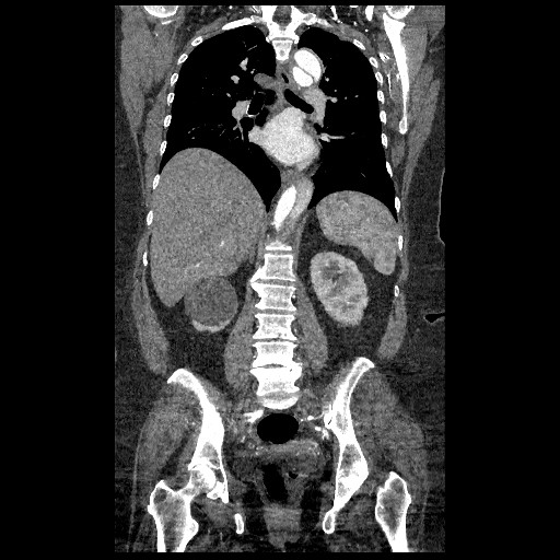 File:Aortic dissection - Stanford type B (Radiopaedia 88281-104910 B 50).jpg