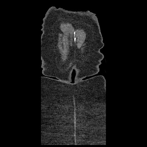 Aortic dissection - Stanford type B (Radiopaedia 88281-104910 B 95).jpg