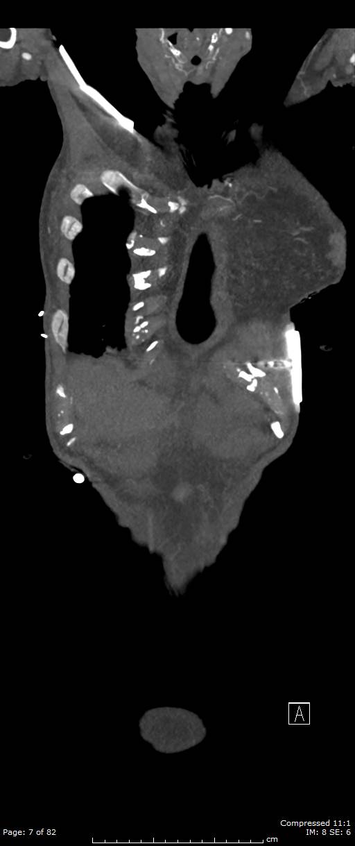 Aortic dissection with extension into aortic arch branches (Radiopaedia 64402-73204 A 7).jpg