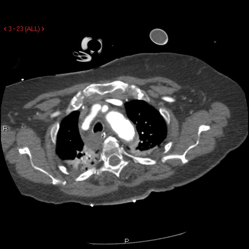 File:Aortic intramural hematoma (Radiopaedia 27746-28001 A 23).jpg