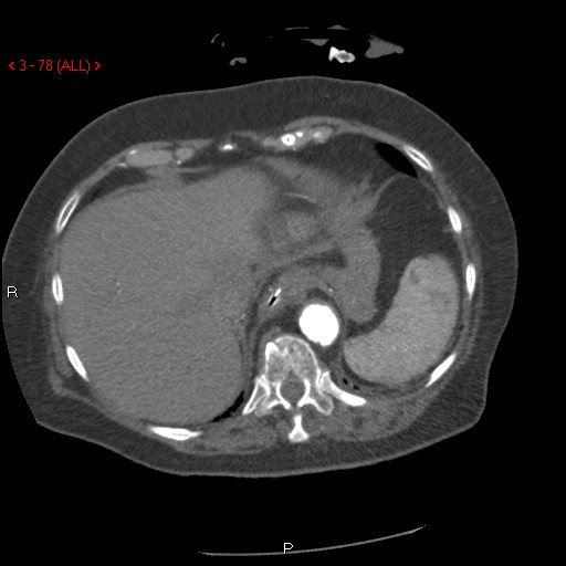 Aortic intramural hematoma (Radiopaedia 27746-28001 A 78).jpg