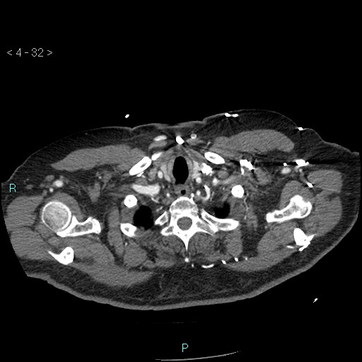 File:Aortic intramural hematoma (Radiopaedia 48463-53380 B 16).jpg