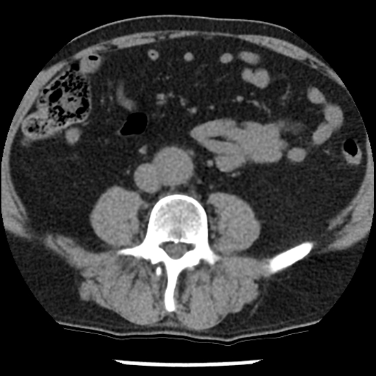 Aortic intramural hematoma (type B) (Radiopaedia 79323-92387 Axial non-contrast 81).jpg
