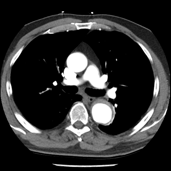 Aortic intramural hematoma (type B) (Radiopaedia 79323-92387 B 22).jpg