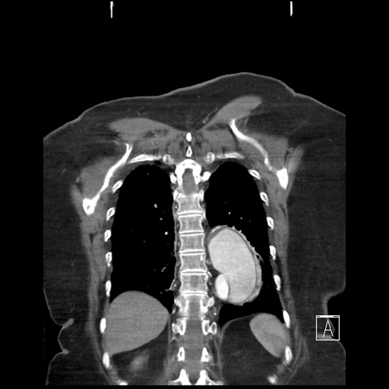 Aortic intramural hematoma with dissection and intramural blood pool (Radiopaedia 77373-89491 C 54).jpg