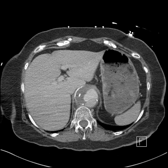 Aortic intramural hematoma with dissection and intramural blood pool (Radiopaedia 77373-89491 E 3).jpg