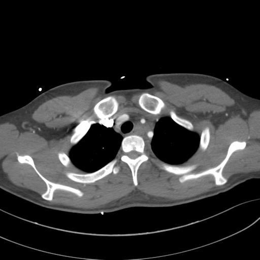 File:Aortic transection (Radiopaedia 29890-30405 A 21).jpg