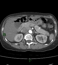 Aortic valve endocarditis (Radiopaedia 87209-103485 C 103).jpg