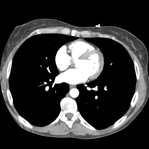 File:Aortic valve non-coronary cusp thrombus (Radiopaedia 55661-62189 B 30).png