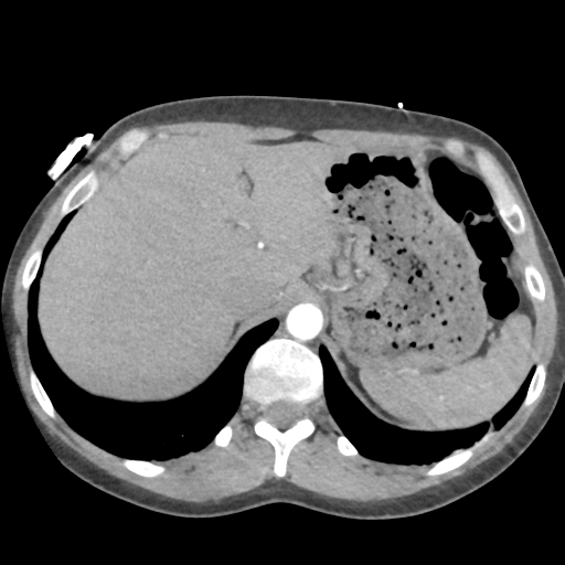 Aortic valve non-coronary cusp thrombus (Radiopaedia 55661-62189 B 48).png