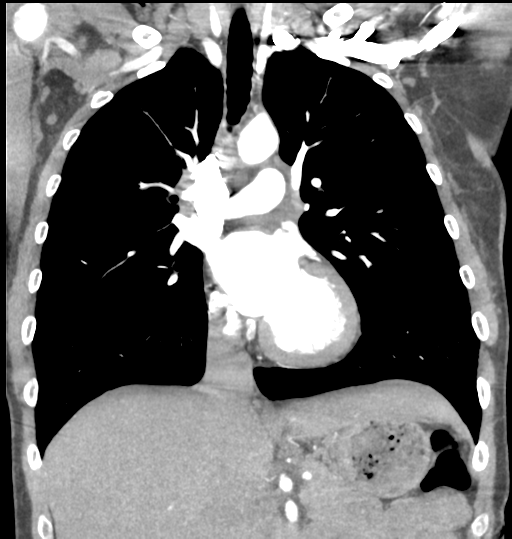 Aortic valve non-coronary cusp thrombus (Radiopaedia 55661-62189 C 37).png
