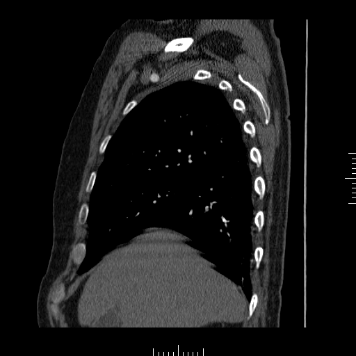 File:Aorto-coronary bypass graft aneurysms (Radiopaedia 40562-43157 C 1).png