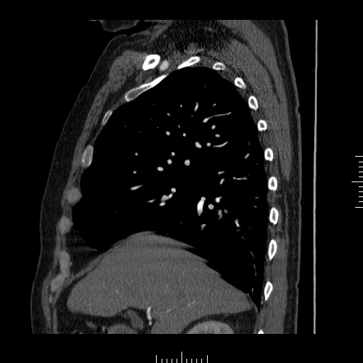 File:Aorto-coronary bypass graft aneurysms (Radiopaedia 40562-43157 C 4).png