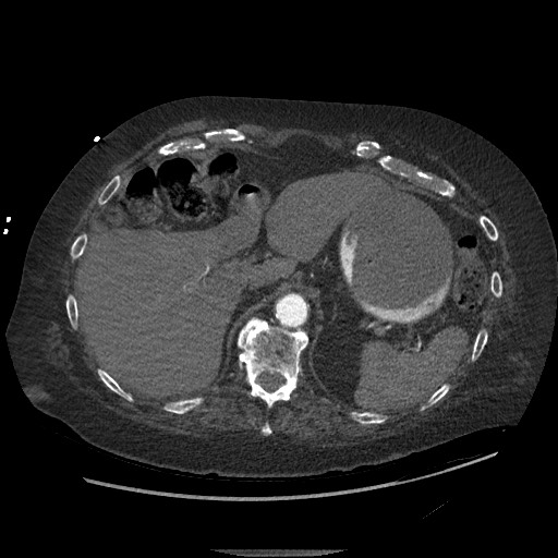 Aortoesophageal fistula with endovascular repair (Radiopaedia 73781-84592 Axial C+ CTPA 167).jpg