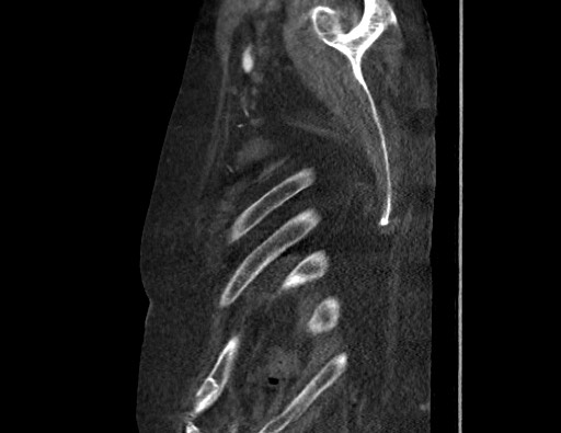 Aortoesophageal fistula with endovascular repair (Radiopaedia 73781-84592 Sagittal C+ CTPA 187).jpg