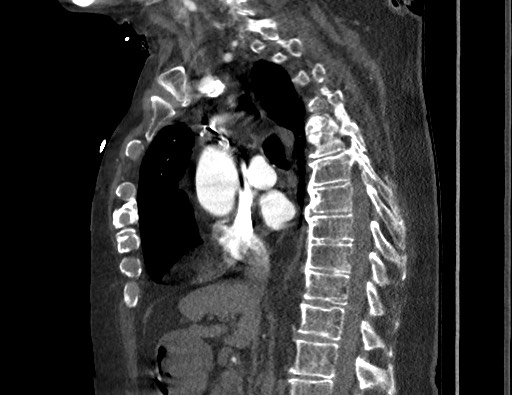 File:Aortoesophageal fistula with endovascular repair (Radiopaedia 73781-84592 Sagittal C+ CTPA 89).jpg