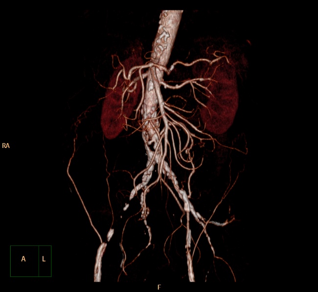 File:Aortoiliac occlusive disease (Radiopaedia 32134-33076 VR C+ arterial phase 15).jpg