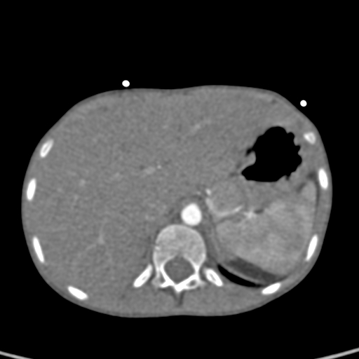 File:Aortopulmonary window, interrupted aortic arch and large PDA giving the descending aorta (Radiopaedia 35573-37074 B 92).jpg