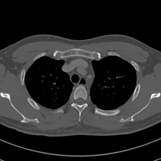 Apical lung mass mimic - neurogenic tumor (Radiopaedia 59918-67521 Axial bone window 20).jpg