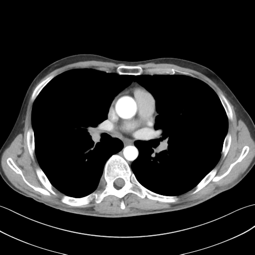File:Apical pleural calcification (Radiopaedia 46141-50499 Axial C+ delayed 33).png