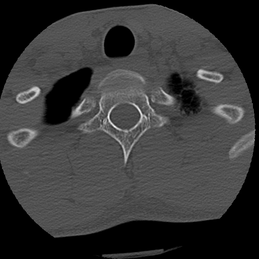 File:Apical pneumothorax on cervical spine CT (Radiopaedia 45343-49368 Axial bone window 85).jpg