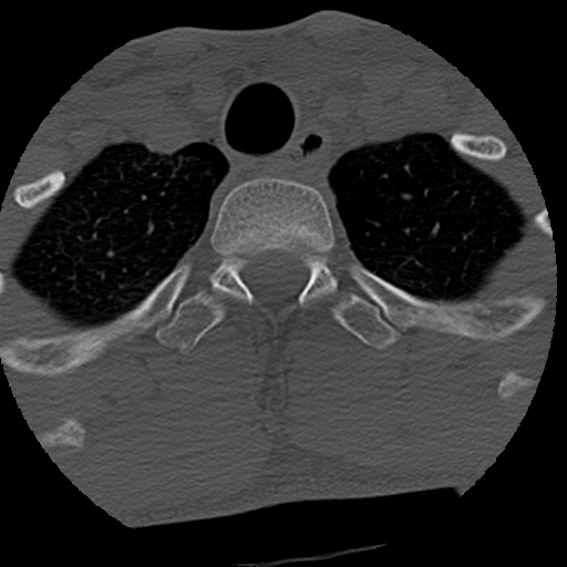 File:Apical pneumothorax on cervical spine CT (Radiopaedia 45343-49368 Axial bone window 92).jpg