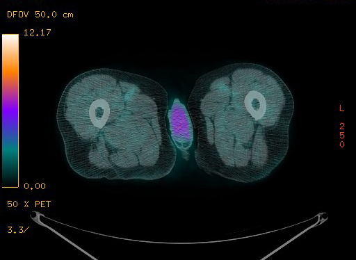 File:Appendiceal adenocarcinoma complicated by retroperitoneal abscess (Radiopaedia 58007-65041 Axial PET-CT 218).jpg