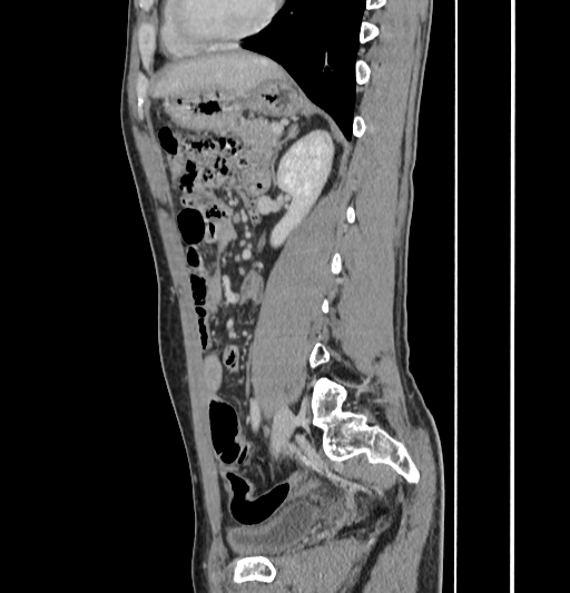 Appendiceal mucinous adenocarcinoma (Radiopaedia 66605-75922 C 43).jpg