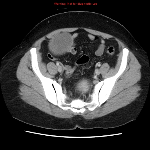 Appendiceal mucinous cystadenoma (Radiopaedia 8263-9111 Axial liver window 64).jpg