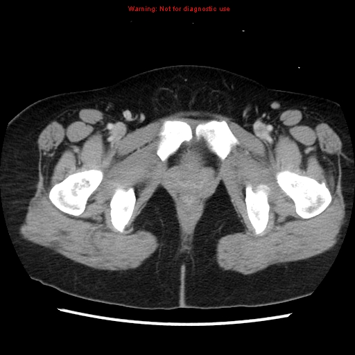 Appendiceal mucinous cystadenoma (Radiopaedia 8263-9111 Axial liver window 82).jpg
