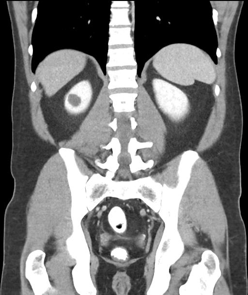 Appendicitis with cecal bar sign (Radiopaedia 31878-32830 A 44).jpg
