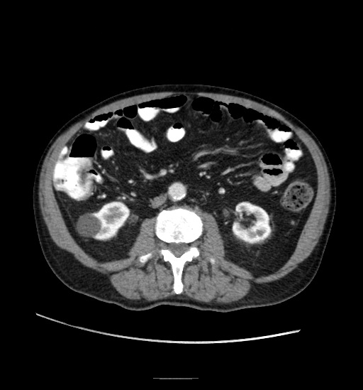 File:Appendicitis with localized perforation and abscess formation (Radiopaedia 49035-54130 A 46).jpg
