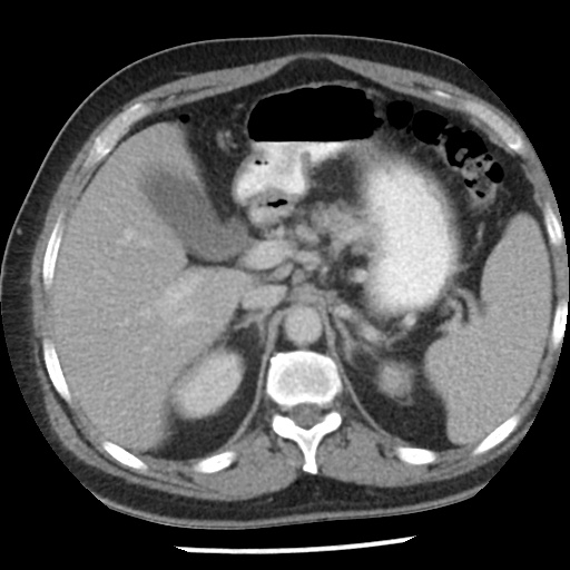 Appendicitis with perforation (Radiopaedia 35790-37342 A 12).jpg