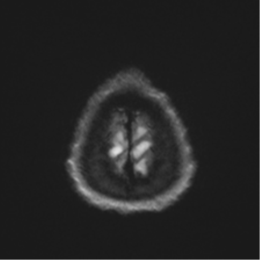 Arachnoid cyst - cerebellopontine angle (Radiopaedia 59689-67083 Axial DWI 71).png
