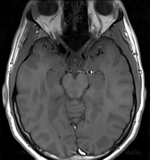 File:Arachnoid cyst - cerebellopontine angle (Radiopaedia 59689-67083 Axial T1 19).png
