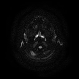 Arachnoid cyst - middle cranial fossa (Radiopaedia 86780-102938 Axial DWI 27).jpg