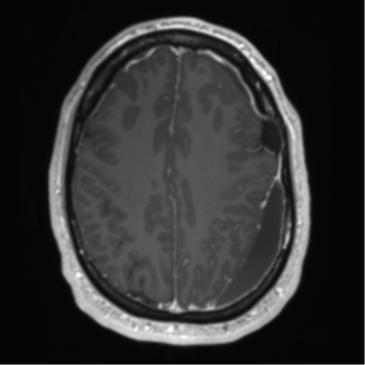 Arachnoid cyst with subdural hematoma (Radiopaedia 85892-101743 Axial T1 C+ 61).png