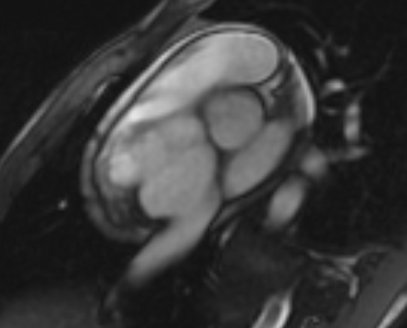 Arrhythmogenic right ventricular cardiomyopathy (Radiopaedia 69564-79464 short axis cine 280).jpg